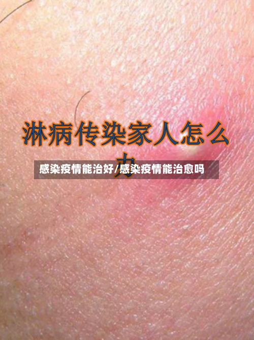 感染疫情能治好/感染疫情能治愈吗-第2张图片